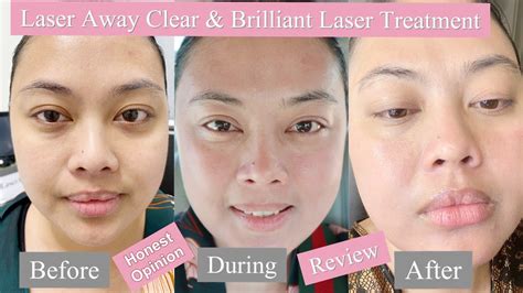 LASERAWAY CLEAR & BRILLIANT, RESULTS||HONEST OPINION & REVIEW FOR THE ...