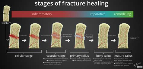 Stages of Fracture Healing Inflammatory - Reparative ... | GrepMed