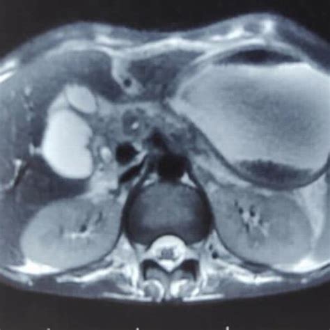 Complete annular pancreas causing compression at 2nd part of duodenum... | Download Scientific ...