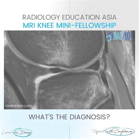 ACL TEAR PIVOT SHIFT INJURY BONE CONTUSION PATTERN OSTEOCHONDRAL ...