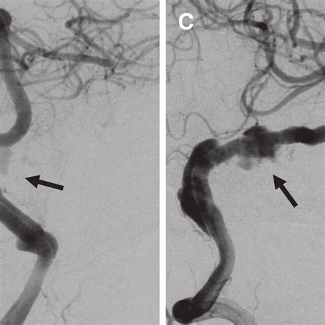 (A) MRI showing a large dolichoectatic vertebrobasilar aneurysm. (B ...