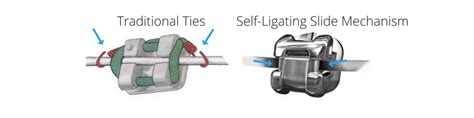 Traditional Braces Versus Self-Ligating Braces