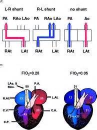 Image result for pulmonary shunt | Pulmonary shunt, Interventional radiology, Respiratory therapist