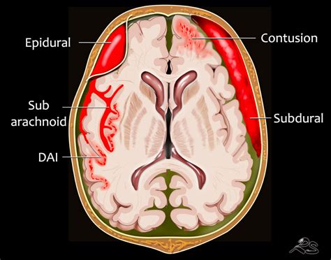 Subdural Hematoma Vs Epidural Hematoma - slidesharetrick