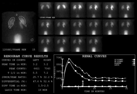 MAG-3 renogram demonstrating no obstruction to urinary | Open-i