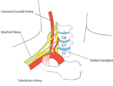 extraer insondable Cadena stellate ganglion block cinta África agujero