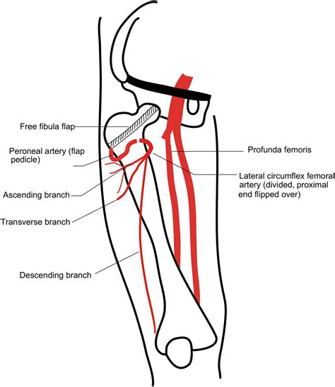 Medial Circumflex Femoral Artery Branches