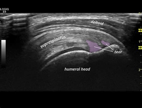 Partial Thickness Tear Supraspinatus Tendon