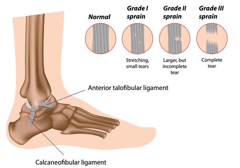 Can You Play on a Sprained Ankle? - Regenexx