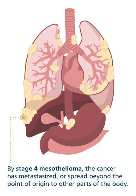 Mesothelioma - What is Malignant Mesothelioma Cancer