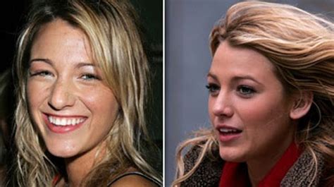 New Celebrity Buzz: Blake Lively Nose Job - Before After