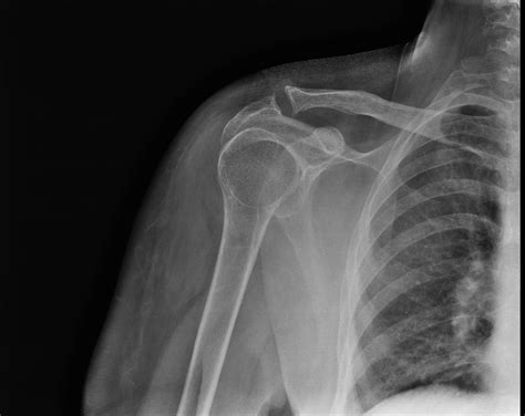 Anterior shoulder dislocation - ultrasound | Image | Radiopaedia.org