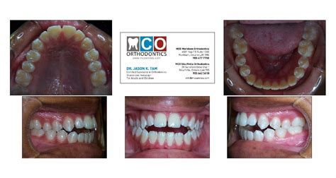 Your Markham Orthodontist, Toronto Invisalign, and Richmond Hill Braces ...