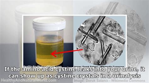 Crystals in Urine: Causes, Home Treatments, and When To See a Doctor - YouTube