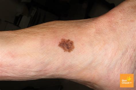 Did You Know You Can Get Malignant Melanoma On Your Feet? - Sutherland Podiatry