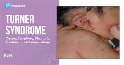 Turner Syndrome: Causes, Symptoms, Diagnosis, Treatment and Complications