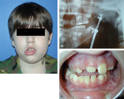 6 Distraction Osteogenesis | Pocket Dentistry