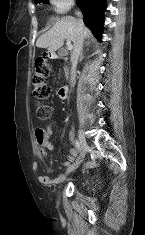 An uncommon right iliac fossa mass in an older woman | The BMJ