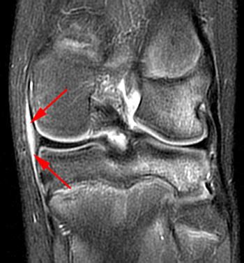 Lateral Capsular Ligament Knee Mri - Chris Mehl Kapsels