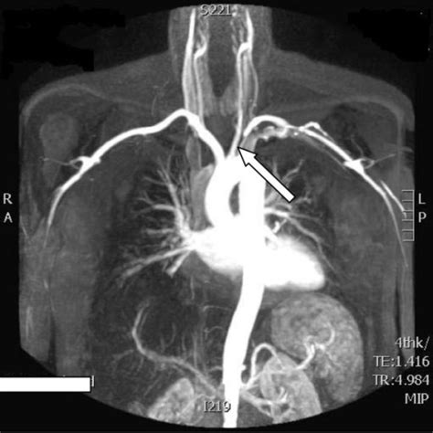 Magnetic resonance angiogram shows stenosis of the prox | Open-i