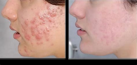 Tretinoin Cream 101: Effects, Benefits, and Best Usage