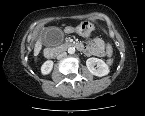 Abdominal CT scan. Causes, symptoms, treatment Abdominal CT scan