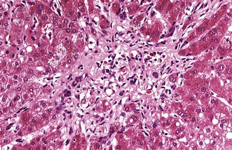 Steatosis, Steatohepatitis and Related Conditions | Abdominal Key