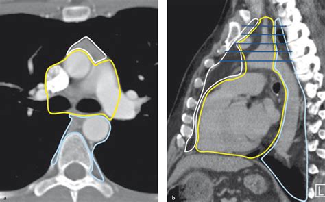 Mediastinum | Radiology Key