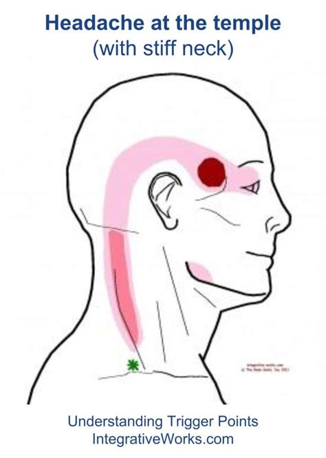 Understanding Trigger Points - Headache in the temple with neck tension and eye tension ...