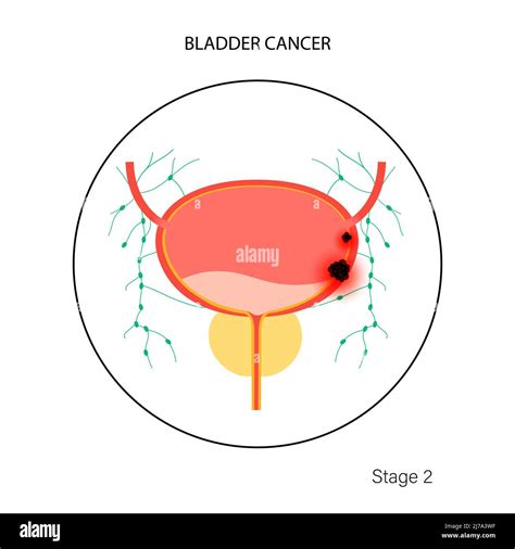 Bladder cancer stages, illustration Stock Photo - Alamy