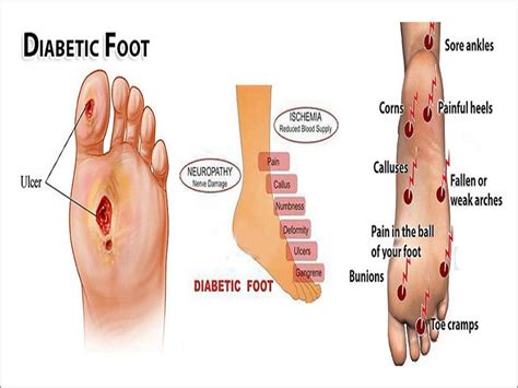 Diabetic Foot Care Clinic in Madurai, Tamil Nadu | Madurai Footcare Centre