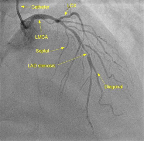 What is distal disease in the LAD? – All About Cardiovascular System and Disorders