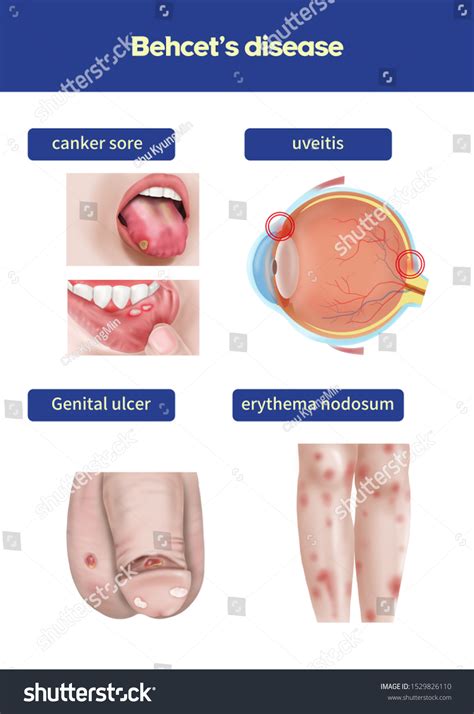 209 Behcets Disease Images, Stock Photos & Vectors | Shutterstock