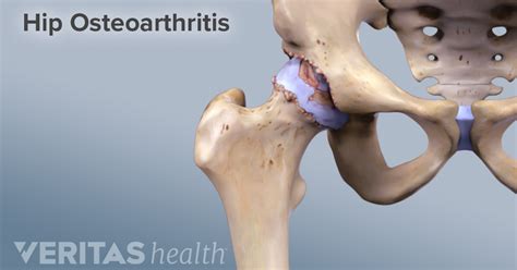 What is Osteoarthritis? | Arthritis-Health