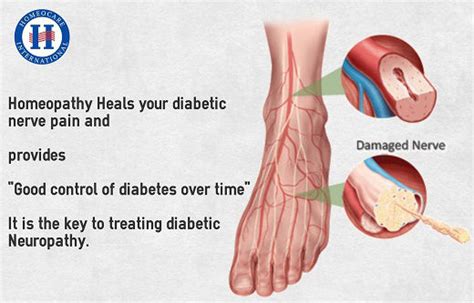 Get best treatment for Diabetic neuropathy