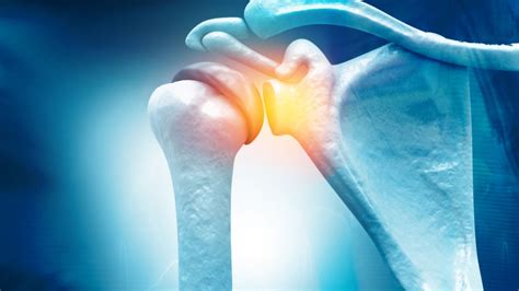 Frozen Shoulder Physiotherapy Treatment - Propel Physiotherapy