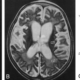 Findings in a 6-year-old girl with stage II SSPE. A, Axial T2-weighted... | Download Scientific ...