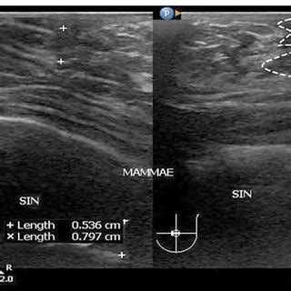 (PDF) Ultrasound Examination of Gynecomastia Case in Male Patient: Case Report