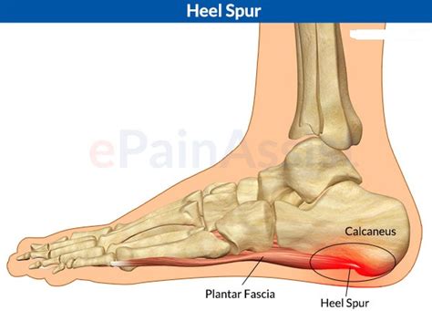 Calcaneal Spur: Symptoms And Treatment | Download Team