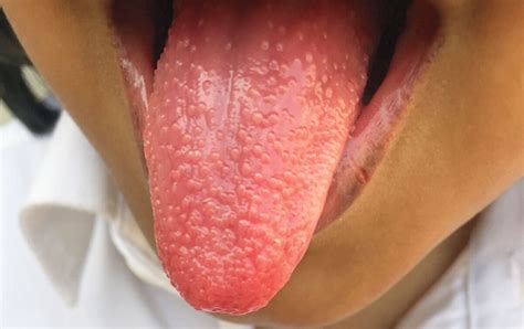 Case of Strawberry Tongue in Streptococcal Pharyngitis reported in NEJM