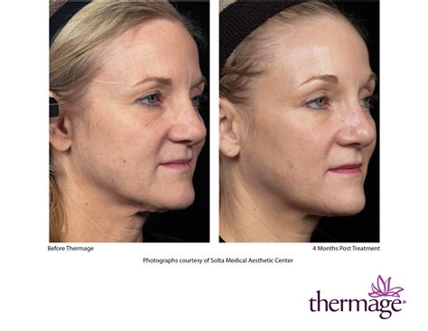 thermage_1 | Cosmetic Laser Centers