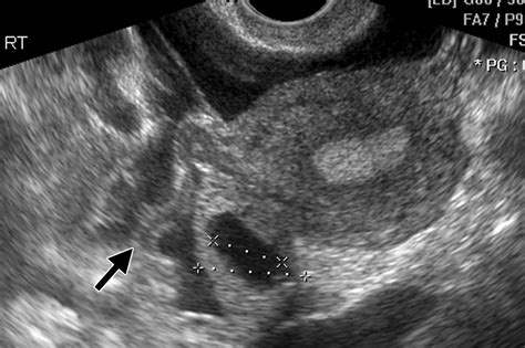 Fallopian Tube Disease in the Nonpregnant Patient | RadioGraphics