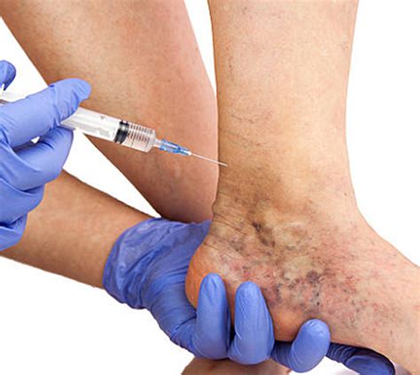 Sclerotherapy for Varicose Veins (New Treatments) · Top Vein Center NYC