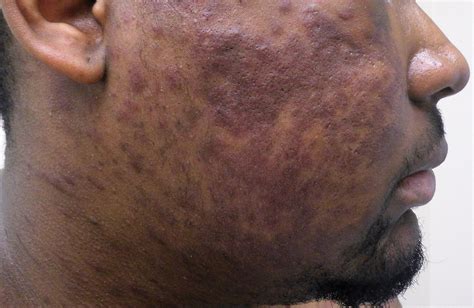 Widespread Purple Plaques | MDedge Dermatology