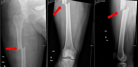 Femoral Shaft Fracture (Thigh Bone Break) | Orthopaedic Trauma Association (OTA)