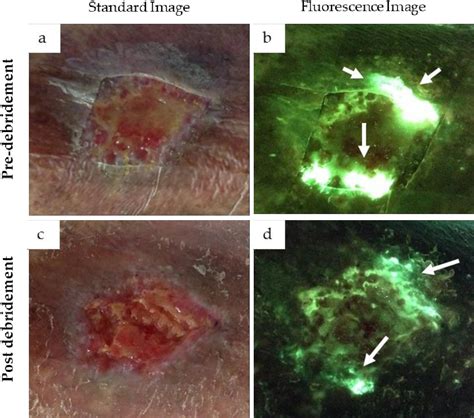 [PDF] Rapid Diagnosis of Pseudomonas aeruginosa in Wounds with Point-Of ...