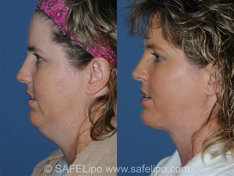 Double Chin Reduction Before and After Pictures Case 350 | SAFELipo®