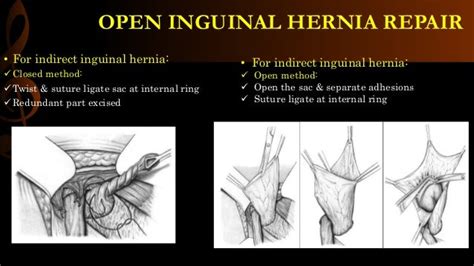 Open inguinal hernia repair / operative surgery