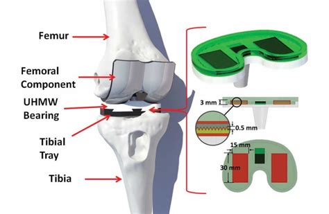 Building a better artificial knee | Binghamton News