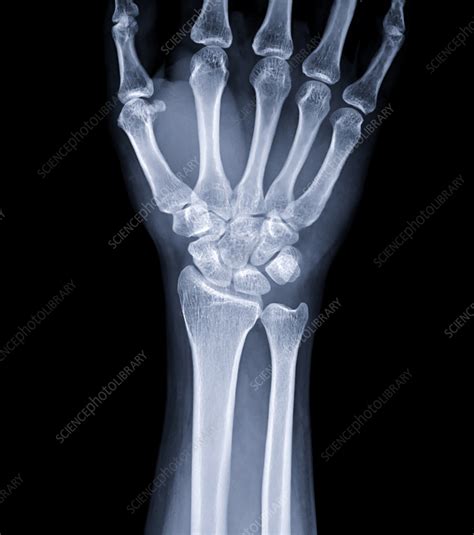 Healthy wrist, X-ray - Stock Image - F037/5163 - Science Photo Library